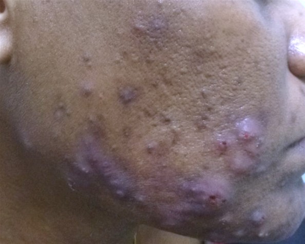 Nodulocystic acne before isotretinoin therapy