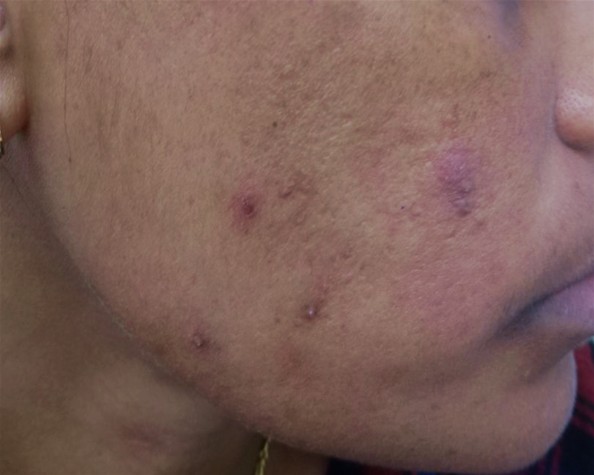Nodulocystic acne during isotretinoin therapy