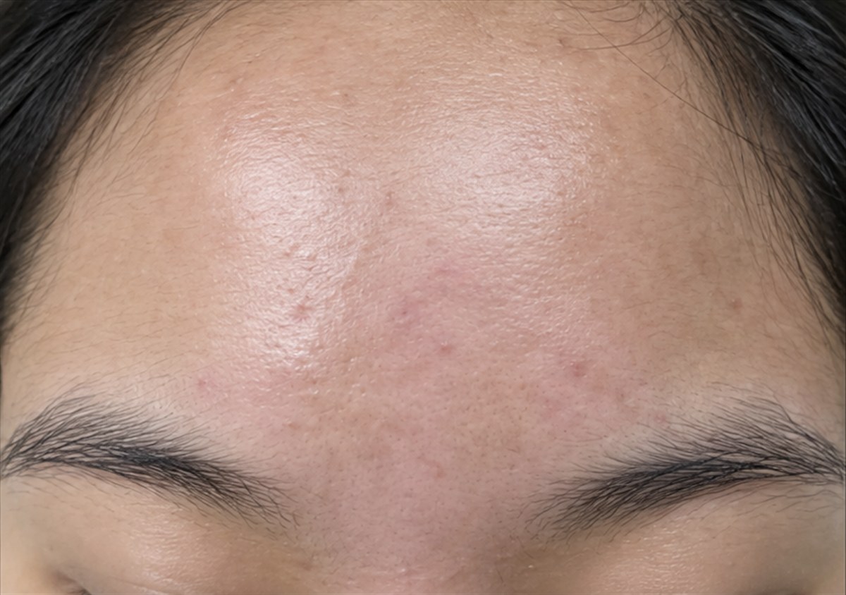 Nodulocystic acne of the forehead after isotretinoin therapy
