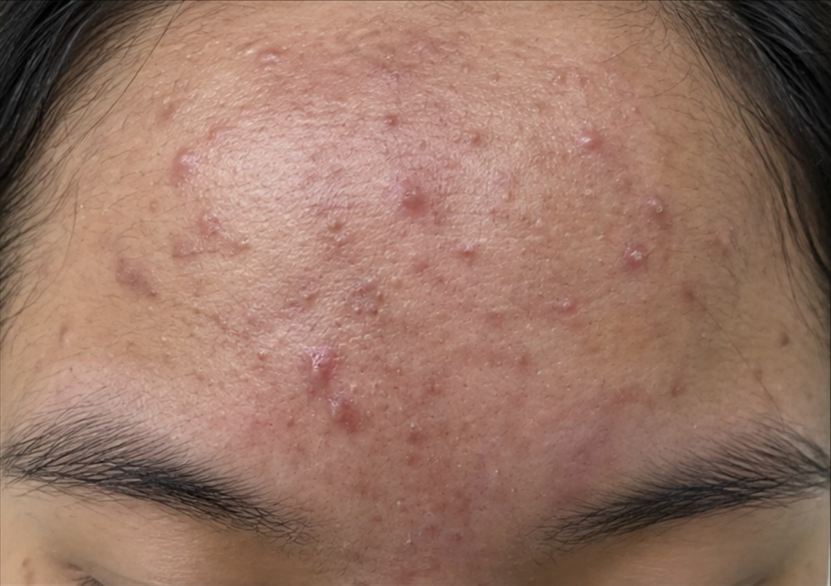 Nodulocystic acne of the forehead before isotretinoin therapy