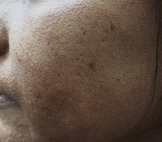 Acne with postinflammatory hyperpigmentation on the cheek after treatment