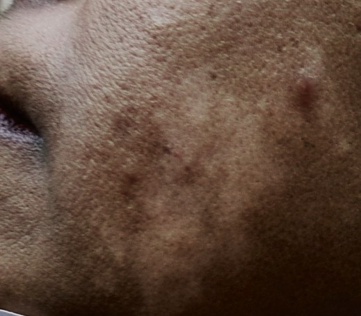 Acne with postinflammatory hyperpigmentation on the cheek before treatment
