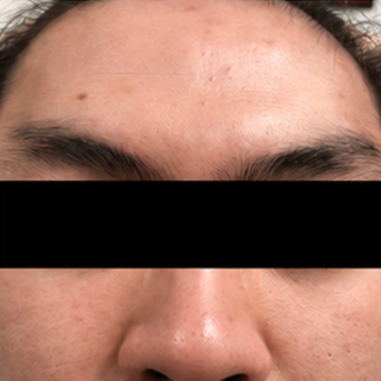 Airborne contact dermatitis of the forehead and face after treatment