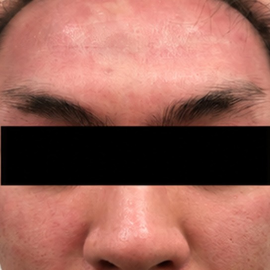 Airborne contact dermatitis of the forehead and face before treatment