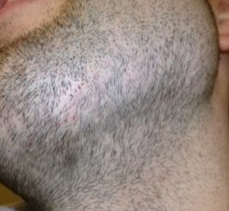 Alopecia areata in the beard area after treatment
