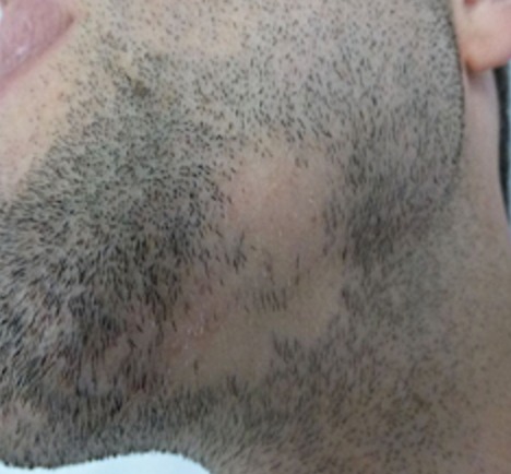 Alopecia areata in the beard area before treatment