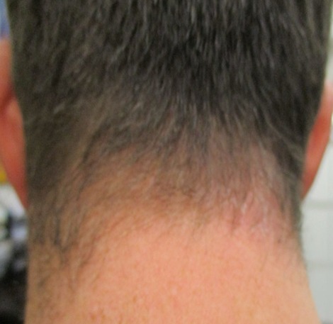 Alopecia areata at the nape of the neck after treatment