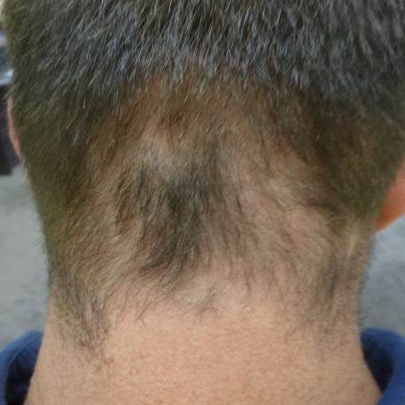Alopecia areata at the nape of the neck before treatment