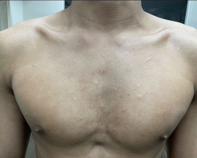 Dermatitis and postinflammatory hyperpigmentation on the chest after treatment