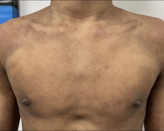 Dermatitis and postinflammatory hyperpigmentation on the chest before treatment