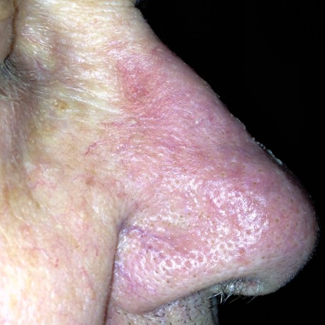 The nose after field treatment of solar keratoses and SCC in situ