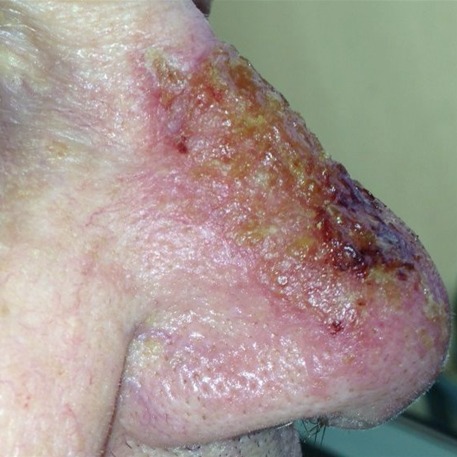 Solar keratoses and SCC in situ on the nose before field treatment