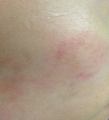 Infected eczema on the cheek after treatment