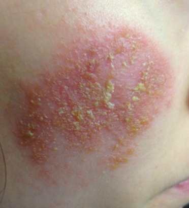 Infected eczema on the cheek before treatment