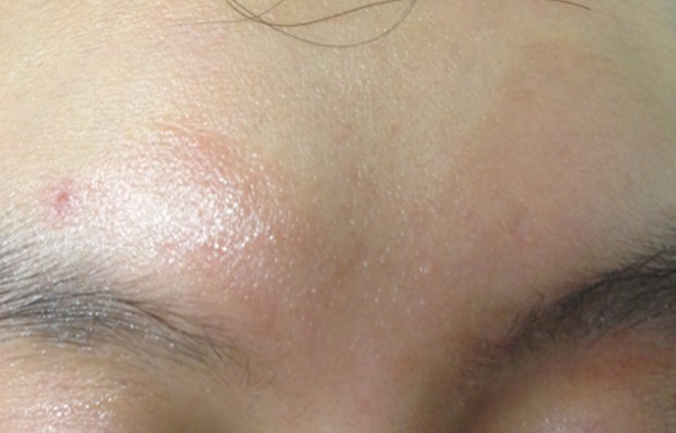 Infected eczema of the forehead and eyebrows after treatment