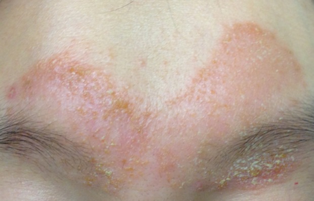 Infected eczema of the forehead and eyebrows before treatment