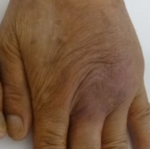 Lichen simplex chronicus on the back of the hand after treatment