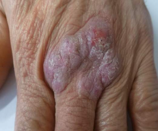 Lichen simplex chronicus on the back of the hand before treatment
