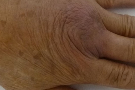 Lichen simplex chronicus over the knuckle (second view) after treatment
