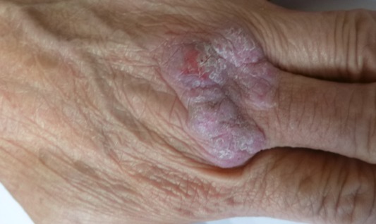 Lichen simplex chronicus over the knuckle (second view) before treatment