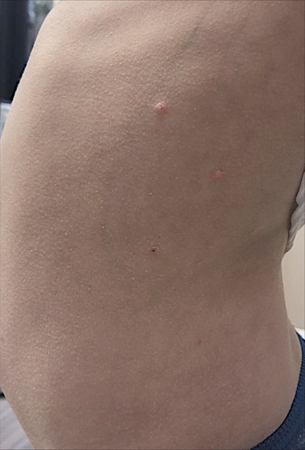 Molluscum contagiosum on the trunk after treatment