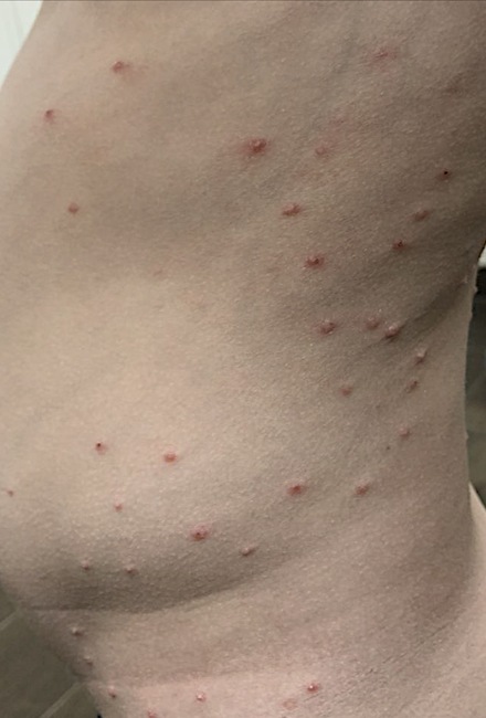 Molluscum contagiosum on the trunk before treatment