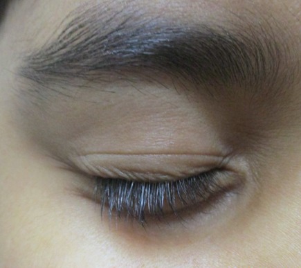 Eyelid and brow skin after treatment of a pigment disorder