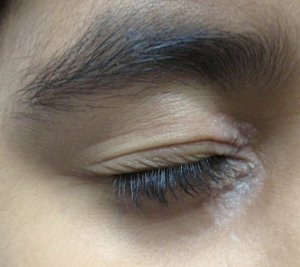 Eyelid and brow skin with a pigment disorder before treatment