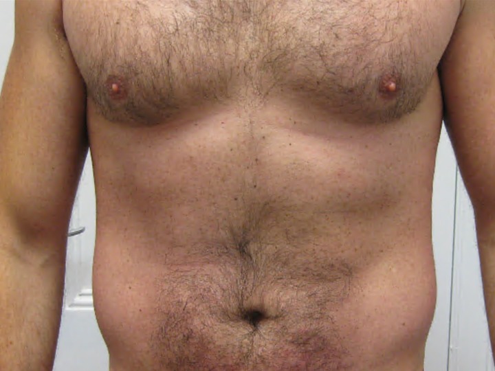 Psoriasis of the trunk and arms after biologic therapy