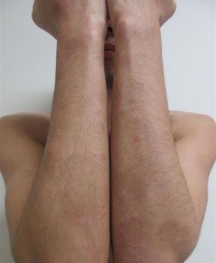 Psoriasis plaques on the forearms and hands after biologic therapy
