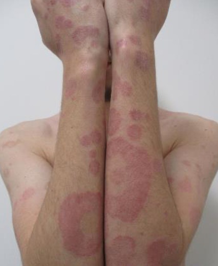 Psoriasis plaques on the forearms and hands before biologic therapy