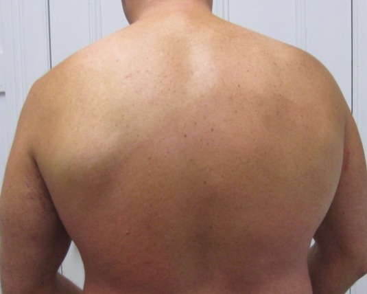 The back after biologic therapy for psoriasis