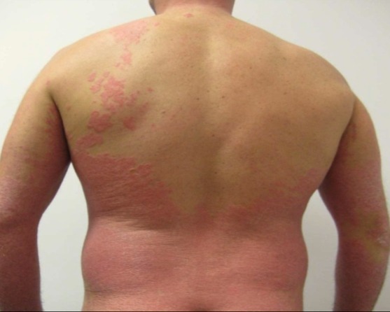 Psoriasis of the back before biologic therapy