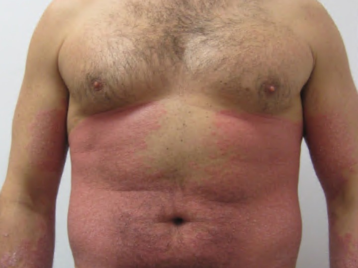 Psoriasis of the trunk and arms before biologic therapy