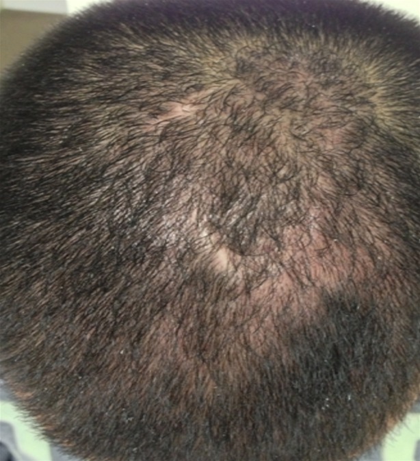Infected seborrhoeic dermatitis after treatment