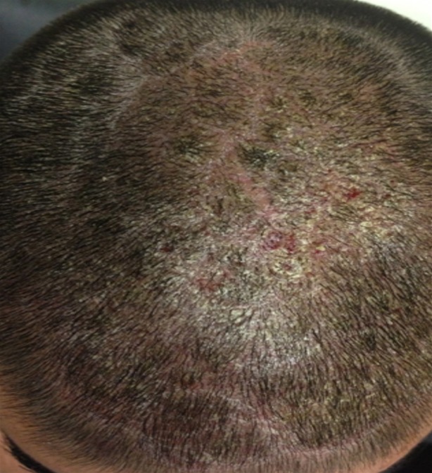 Infected seborrhoeic dermatitis before treatment