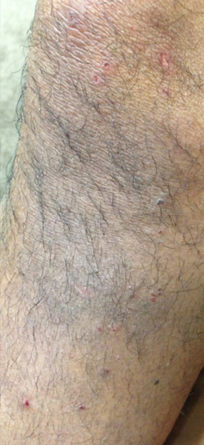 Tinea incognito on the arm after treatment