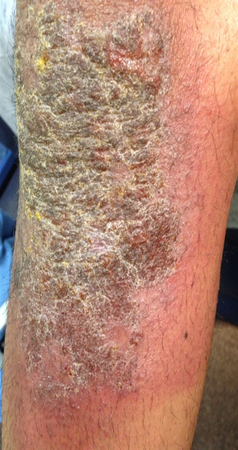 Tinea incognito on the arm before treatment