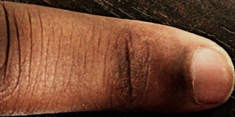 Vitiligo after treatment