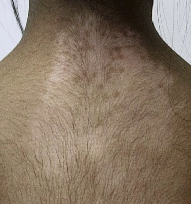 Vitiligo on the upper back and neck after treatment