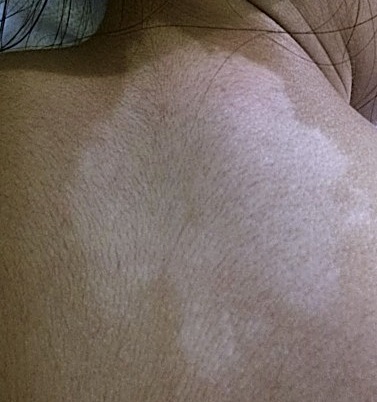 Vitiligo on the upper back and neck before treatment