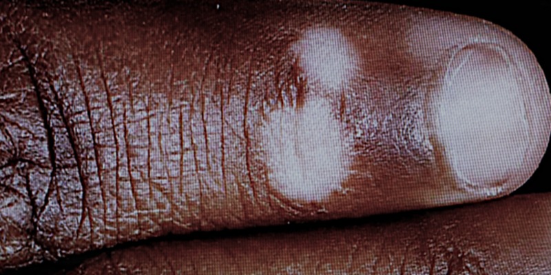Vitiligo before treatment
