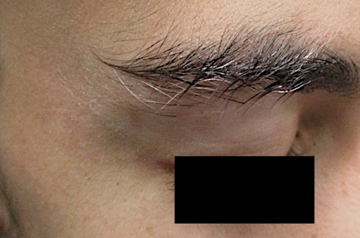 Vitiligo around the eyebrow and eyelid after treatment