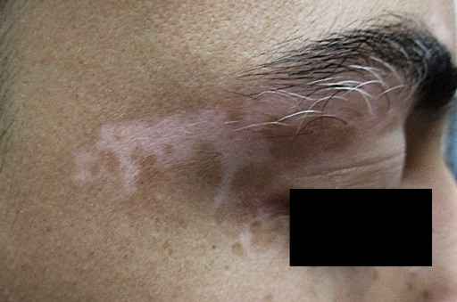 Vitiligo around the eyebrow and eyelid before treatment