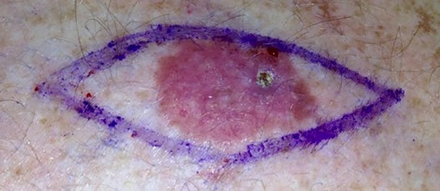 Basal cell carcinoma (BCC)