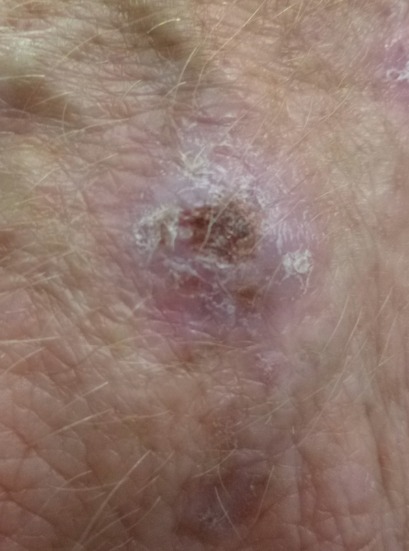 Squamous cell carcinoma (SCC) on the dorsal hand
