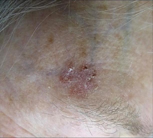 SCC in-situ (Bowen’s disease)