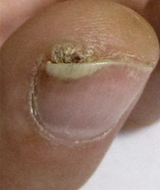 Periungual wart (beside the nail)