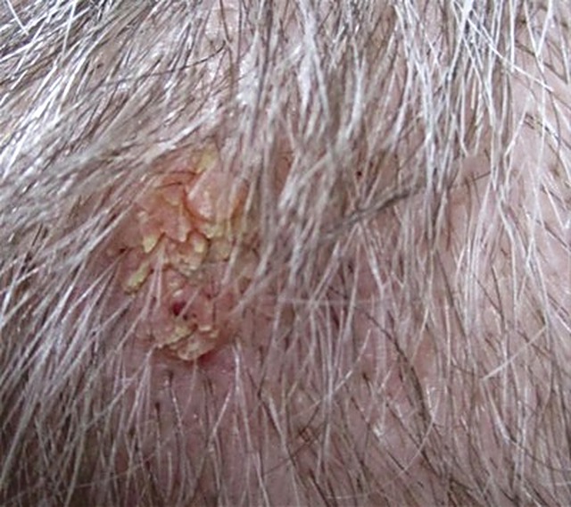 Wart on the scalp