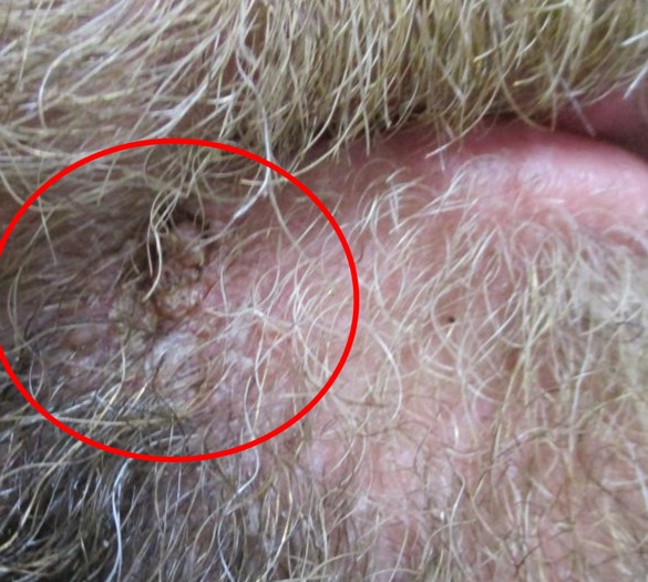 Wart in the beard area (circled)